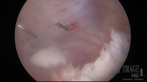 An internal image taken during an Arthrocopy procedure of a floating fragment found loose in a horse’s stifle. Photo Courtesy: Dr. Marcos Perez.
